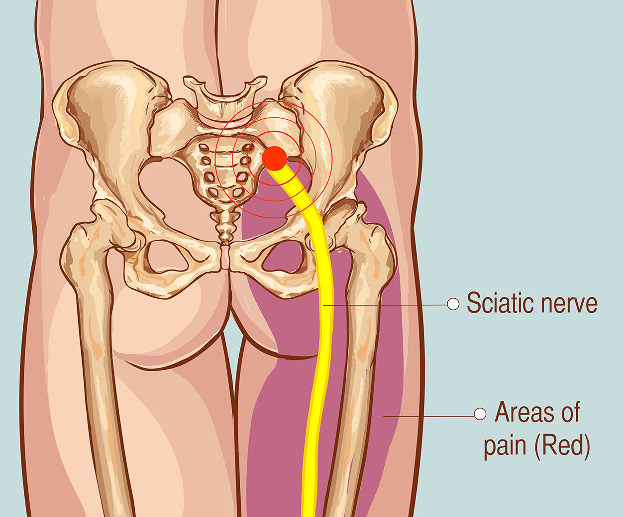symptoms of sciatica pain in leg